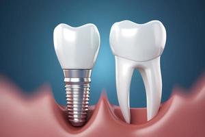 Realistic dental implant. Teeth treatment. Generate Ai photo