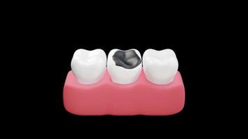 Tooth extraction 3d animation video
