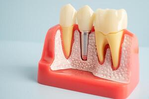 Dental implant, artificial tooth roots into jaw, root canal of dental treatment, gum disease, teeth model for dentist studying about dentistry. photo