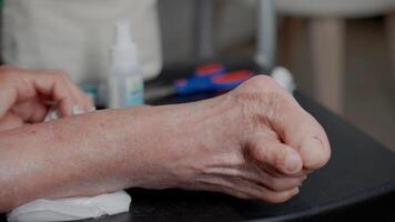 Elderly Woman Foot with HALLUX VALGUS Treatment video